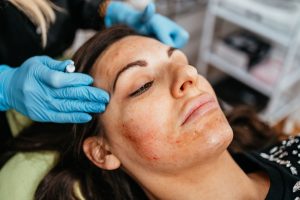 Woman receiving PRP microneedling treatment in a modern skincare clinic.